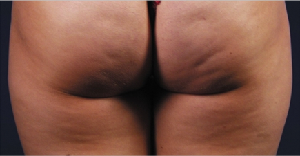 apres-la-liposculpture