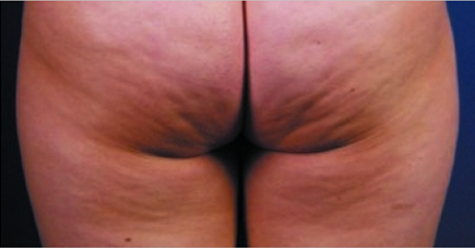 avant-la-liposculpture